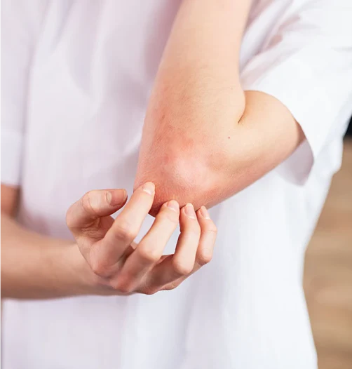 Skin Irritation